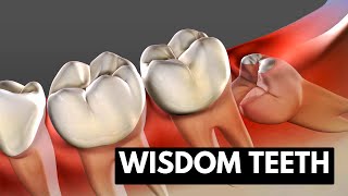 Wisdom teeth Causes Symptoms and Treatment [upl. by Adama]