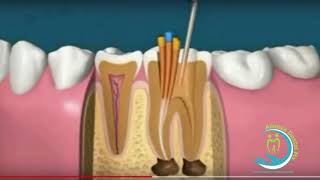 LA ENDODONCIA [upl. by Antonella]