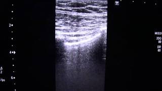 Pleural Sliding SignMP4 [upl. by Anaehr]