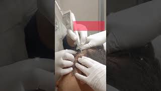 Seborrheic keratosis treatment  Laser Treat [upl. by Bidle705]