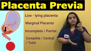 Placenta Previa  APH  Antepartum HemorrhageTypes Risk factors Signs Symptoms  Nursing Lecture [upl. by Anesuza]