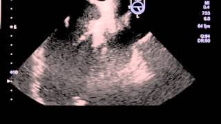 Infective Endocarditis of Aortic Valve Transesophageal Ecocardogram [upl. by Oznohpla264]