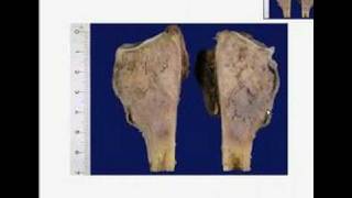 Histopathology Bone Osteosarcoma [upl. by Zurn95]