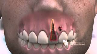 How to treat a dental Fistula [upl. by Notsek]