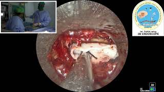 Rt L5S1 endo discectomy [upl. by Christos741]