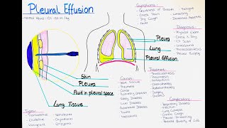 Understanding Pleural Effusion  Causes Symptoms Diagnosis Treatment Complications Types [upl. by Eimas]