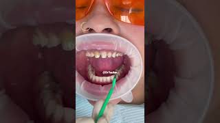 Porcelain veneers procedure  dental veneers procedure step by step  smile makeover  Dr Yazdan [upl. by Epperson486]