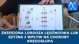 Spłycona zniesiona lordoza lędźwiowa  Przyczyna chorób kręgosłupa  Ćwiczenia  🇵🇱 🇪🇺 [upl. by Santa]