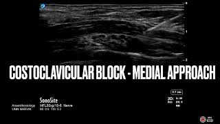 Costoclavicular block  medial approach  Regional anesthesia ultrasound regionalanesthesia [upl. by Beane]