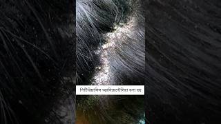 Pityriasis amiantacea 🔥 skincare haircare dandruff psoriasis [upl. by Anilad]