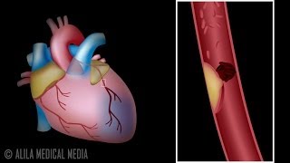 Myocardial Infarction and Coronary Angioplasty Treatment Animation [upl. by Joceline]