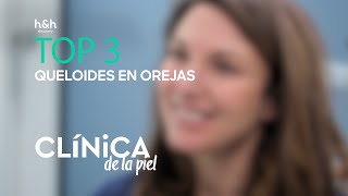 Top 3 Queloides en orejas  Clínica de la piel  Discovery Home amp Health [upl. by Anaitit]