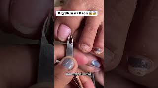 nails removingingrown nailart ingrownails satisfying ingrowntreatment dryskin dryskinnail [upl. by Nylqcaj]