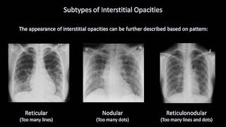 How to Interpret a Chest XRay Lesson 7  Diffuse Lung Processes [upl. by Davies73]