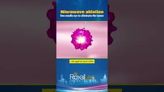 Microwave Ablation  RoyalLee Cancer Hospital [upl. by Lemor912]