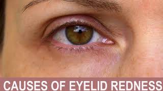 Causes of Eyelid Redness [upl. by Aela]