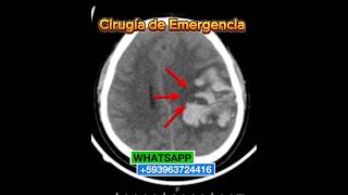 La Hemorragia cerebral cirugía de emergencia hemorragiacerebral [upl. by Jonathan917]