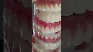 Full process for full mouth implants Zirconia [upl. by Nwotna]