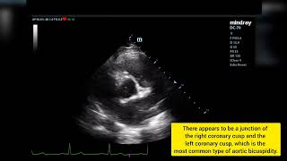 Válvula aórtica bicúspide Ecocardiograma tt  Bicuspid aortic valve on Transthoracic Echocardiogram [upl. by Drusus873]