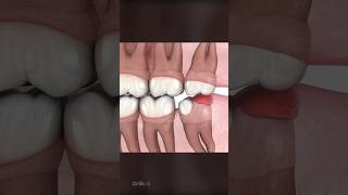 Should You Remove Wisdom Teeth [upl. by Reynard406]