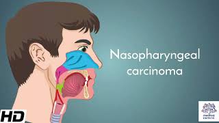 Nasopharyngeal carcinoma Causes Signs and Symptoms Diagnosis and Treatment [upl. by Lotz]