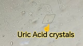 فحص الادرار Urine examination Urine analysis Uric Acid crystals pus cells epithelial cells [upl. by Shrier]