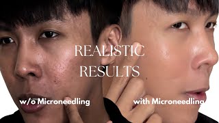 Lets do Microneedling on half of my face  Acne scars treatment [upl. by Eniamsaj]