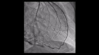 Constrictive Pericarditis [upl. by Ellsworth]