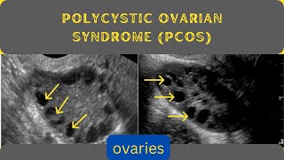 Enlarged Ovaries  Polycystic Ovarian syndrome PCOS  Ultrasound [upl. by Ellenej]