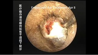 A case of cholesteatoma misdiagnosed as cerumen embolism [upl. by Aseyt327]