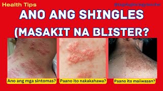 Shingles Masakit na blisters Signs amp Symptoms  Health Tips 7 Tagalog [upl. by Wye]