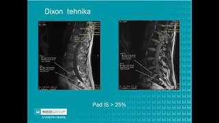 MediGroup webinar dr Vesna Vuković Onkološka MR evaluacija kičme na 3T magnetu [upl. by Anirda]