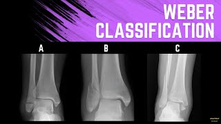 Weber Classification Ankle Fractures [upl. by Ylrahc511]