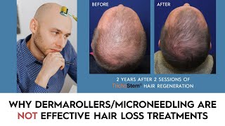 Why DermarollersMicroneedling for Hair Loss have Minimal Results [upl. by Darryl]