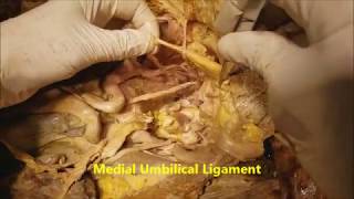 Pelvic Narrative Surgical Dissection  Iliac Artery Branches  Sanjoy Sanyal [upl. by Sigfrid696]