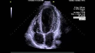 Case 1  Severe Aortic Regurgitation [upl. by Rehpotsyrhc45]