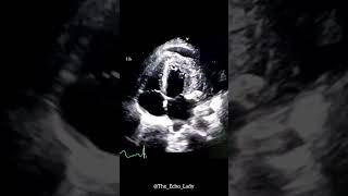 Huge cardiac mass echocardiography cardiology echocardiogram cardiologia ECG [upl. by Analiese]