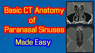 Basic CT Anatomy of Paranasal Sinuses Made Easy [upl. by Lidia]