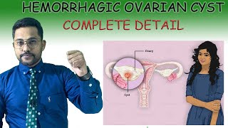 HEMORRHAGIC OVARIAN CYST Treatment [upl. by Leumhs69]