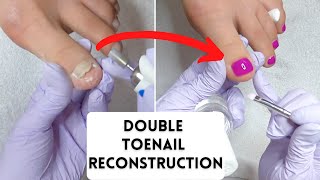 Double Toenail Reconstruction With LCN Barefoot Gel And Gehwol Nail Repair Gel [upl. by Eeralih]