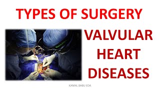 TYPES OF SURGERY VALVULAR HEART DISEASES [upl. by Natiha]