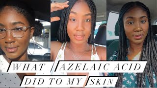 WHAT USING AZELAIC ACID DID TO MY SKIN [upl. by Hael]