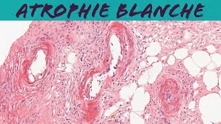 Atrophie blanche livedoid vasculopathy dermatology dermpath pathology [upl. by Anailuig]