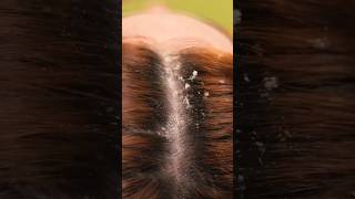 Homemade Shampoo For Hair Fall  Hair Care Tips  Best Home Remedies For Hair Fall [upl. by Ajnos]