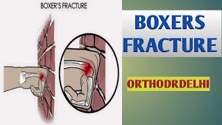 BOXERS FRACTURE IN HINDIFRACTURE OF FIFTH METACARPAL IN HINDIFRACTURE OF HAND BONE IN HINDI [upl. by Netsuj]