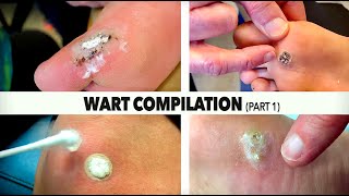 WART BURNING COMPILATION Part 14  Dr Paul [upl. by Terence742]