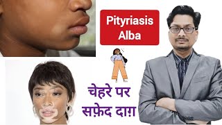 चेहरे पर सफ़ेद दाग़  Pityriasis Alba vs Vitiligo vitiligo vitiligotreatment leucoderma faceskin [upl. by Kaitlin458]