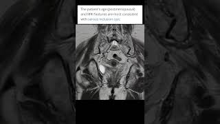 Serous inclusion cyst of ovary mri radiologysonology youtubeshorts shortvideo ctisus [upl. by Colier609]