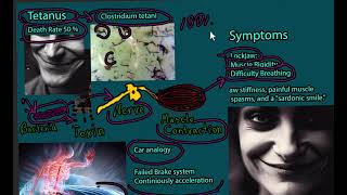 Tetanus Disease Lockjaw  signs and symptoms prevention treatment and prognosis [upl. by Aissela]