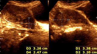 Three cases of Leiomyoma Uterus  Abnormal Uterine Bleeding  sonographic prediction [upl. by Ltsyrk]